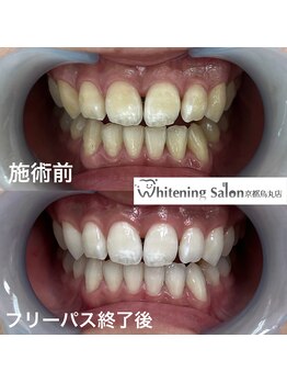 ホワイトニングサロン 京都烏丸店/ホワイトニング施術例