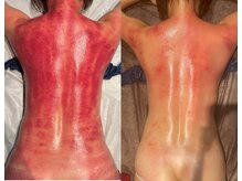 スピード美人 本八幡店/続けることでアザ出なくなります