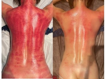 スピード美人 本八幡店/続けることでアザ出なくなります