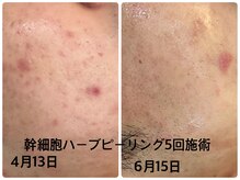 デューン 蕨店(Dune)/肌質ケア