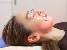 【美容鍼】痛みの少ない、心地の良い美容鍼。