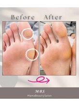 MBS/フット角質ケア