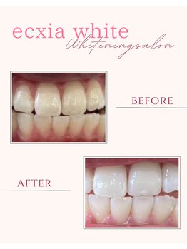 エクシアホワイトニング 奥田店/ホワイトニングビフォーアフター