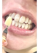 プラチナムビューティー 武蔵小山/歯科医が認めるホワイトニング