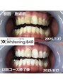 ホワイトニングバー 新潟店&nbsp; #しみないホワイトニング #効果実感ホワイトニング 