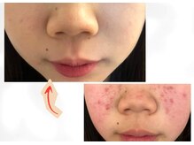 香嬉琉/ニキビ肌、肌荒れ、乾燥肌に