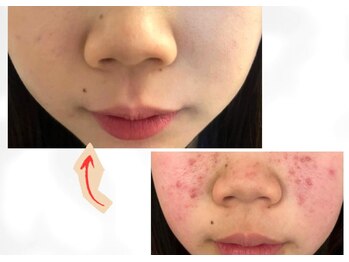 香嬉琉/ニキビ肌、肌荒れ、乾燥肌に