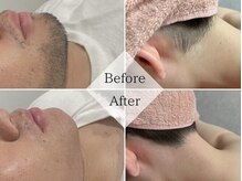 【光脱毛×WAX脱毛】で即日チクチク肌から解放！