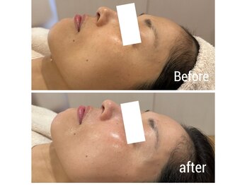 前田さんちのエステサロン ドゥース(douce.)/Before/after