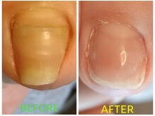 フットスタジオ アルク(FOOT STUDIO ALUK)の雰囲気（どんな巻き爪や深爪も高い技術力で対応します！ご相談ください！）