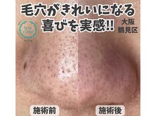 リッカロッカ(RIKKA&ROCCA)/毛穴エクストラクション