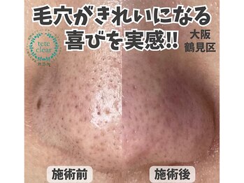 リッカロッカ(RIKKA&ROCCA)/毛穴エクストラクション