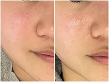 マグノリア(Magnolia)/毛穴洗浄×ソニック＊毛穴開きに