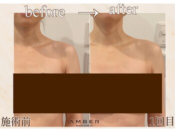 アンバー 恵比寿(AMBER)/デコルテの張りにも