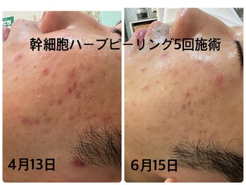 デューン 蕨店(Dune)/メンズエステ【施術3回】