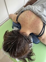 耀 カガヤキ/ルート鍼60分コース