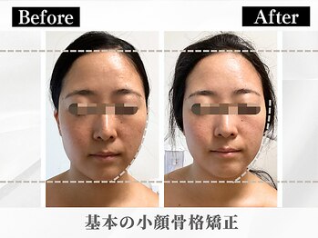 ポーベルポー(Peau Belle poe)/フェイシャル小顔矯正＋パック