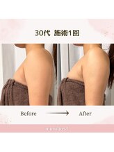 ミミバスト(mimibust)/バストアップBeforeAfter
