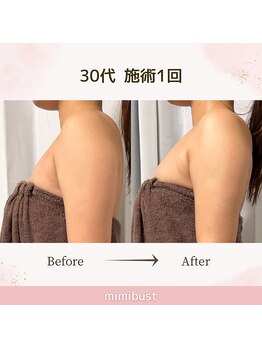 ミミバスト(mimibust)/バストアップBeforeAfter