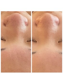 プルクレ 常磐町店(Pulchre)/肌質改善♪