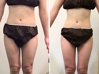 ビー 松本店(Be.. .)の写真/【男女ご利用OK】ラジオ波＋キャビテーション痩身7700円★部位or全身OK！リバウンドが不安な方にも◎