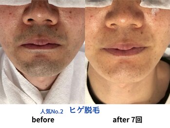 ノノケケ(NONOKEKE)/【メンズ脱毛】　ヒゲ脱毛