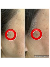 かず整骨院/光美容でほくろのブツブツが改善