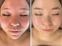 オレアグリーン 岡崎(OLEA green)の雰囲気（期間限定スペシャルクーポン/毛穴/ハーブピーリング/小顔/リンパ）