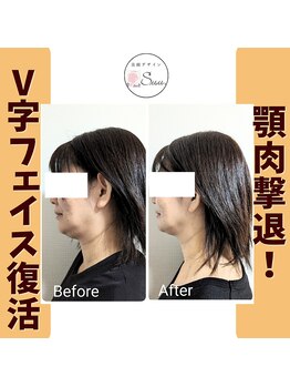 美顔デザインsuu.~若見えと歪み矯正専門の小顔サロン~/Before-After【40代】8 回