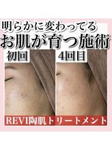 ホワイトアクア 天王寺本店(WHITE AQUA)/ハーブピーリング/大阪/天王寺