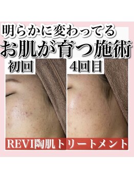 ホワイトアクア 天王寺本店(WHITE AQUA)/ハーブピーリング/大阪/天王寺