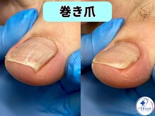 プラスワンフット 本厚木(+1 Foot)/軽い巻き爪でも痛い…