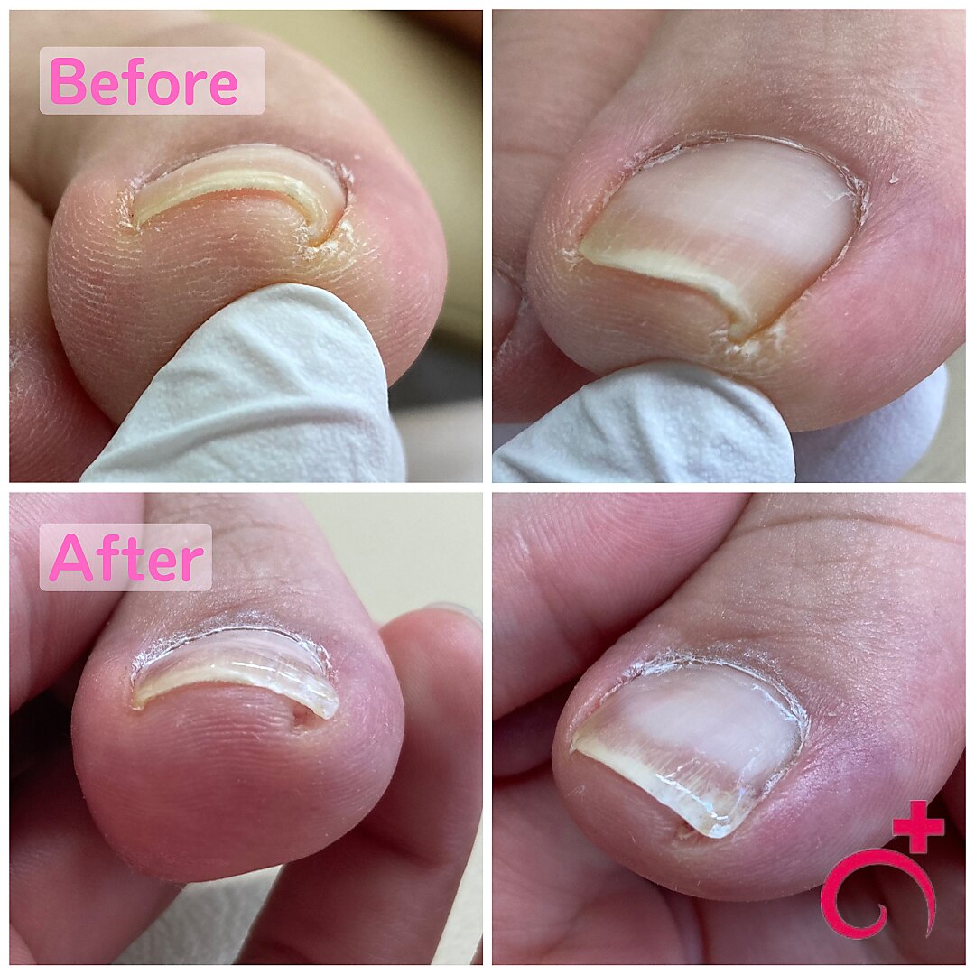 【最先端のネイルケア！】巻き爪補正♪　１ヶ所\9900→\5500〜