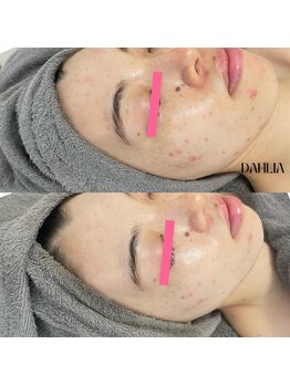 ダリア(Dahlia)/ハーブピーリング