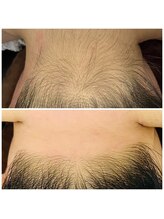 エリー(ERIE)/うなじWax（艶肌Wax)