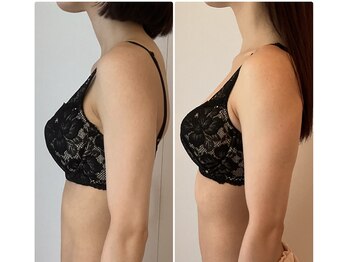 美バストアルファ(美bust α)/【バストアップ】症例