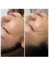 晴(haru)/シェービングだけで艶肌うっとり