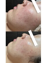 フィール(feel)/ビフォー　アフター　1回施術