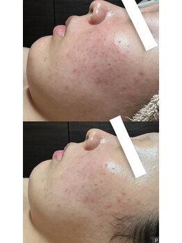 フィール(feel)/ビフォー アフター 1回施術