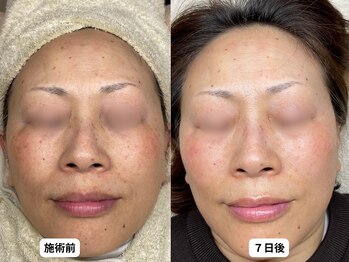 エングラッシー(en glassy)/BEFORE　AFTER　最新シミ回収