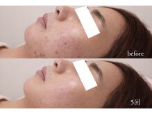 カプロ ボゥ(Capullo.Beau)の雰囲気（40代から顎に繰り返す大人ニキビに、もう悩まない選択。5回施術）