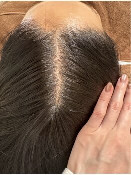 アマリージョヒラソル/Lit ヒト幹細胞エステ