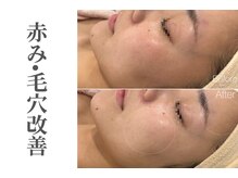 エトレ(etre)/月１サロン敏感/乾燥/赤み/鎮静