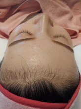 キアラ 麻布十番(Kiara)/顔脱毛