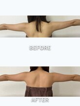 スマイル(SMILE)/二の腕before after