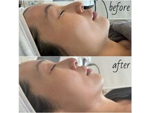 ソア ド ビューティー(SOA_de_beauty)の雰囲気（ピーチリフトで法令線・フェイスライン・シワ等のたるみ改善♪）