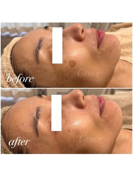 グレイス/最新光フォト