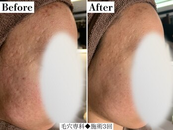 フレイヤ(FREYA)/毛穴専科Before→After