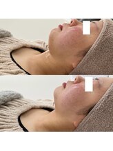 ヴェルシック(Belchic)/顎下がスッキリして首が長く