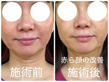 皇漢堂鍼灸療院/最新美容鍼【ダーマ鍼】での変化